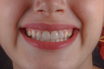 teeth whitening at home guide for a brighter-looking smile
